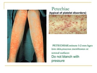 Petechiae   PETECHIAE:minute 1-2 mm hges into skin,mucous membranes or serosal surfaces   Do not blanch with pressure (typical of platelet disorders) 