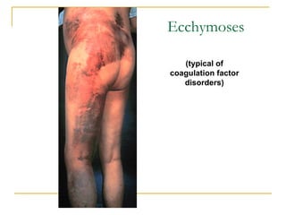 Ecchymoses (typical of coagulation factor disorders) 