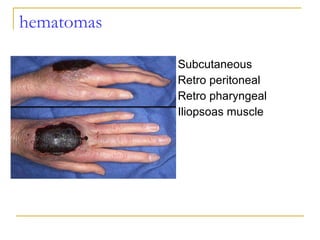 hematomas Subcutaneous Retro peritoneal Retro pharyngeal Iliopsoas muscle 