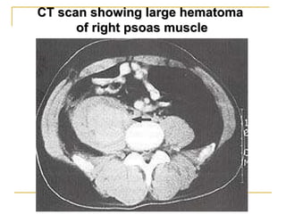 CT scan showing large hematoma  of right psoas muscle 