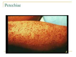 Petechiae 