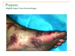 Purpura :slightly larger 3 mm haemorrhages 