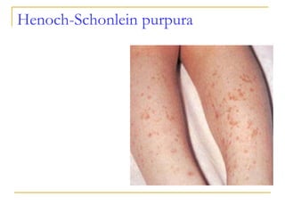 Henoch-Schonlein purpura 