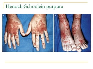 Henoch-Schonlein purpura 