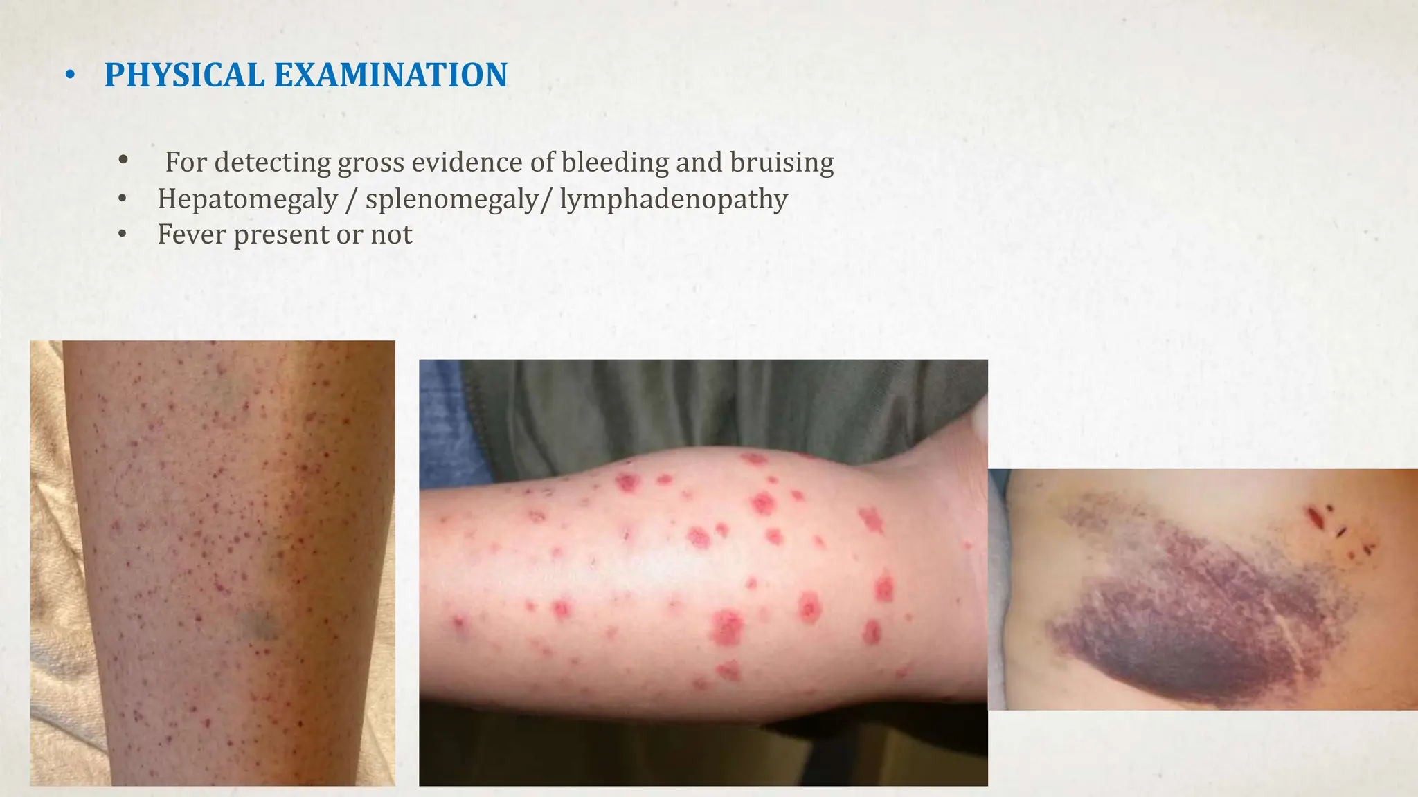 • PHYSICAL EXAMINATION
• For detecting gross evidence of bleeding and bruising
• Hepatomegaly / splenomegaly/ lymphadenopathy
• Fever present or not
 