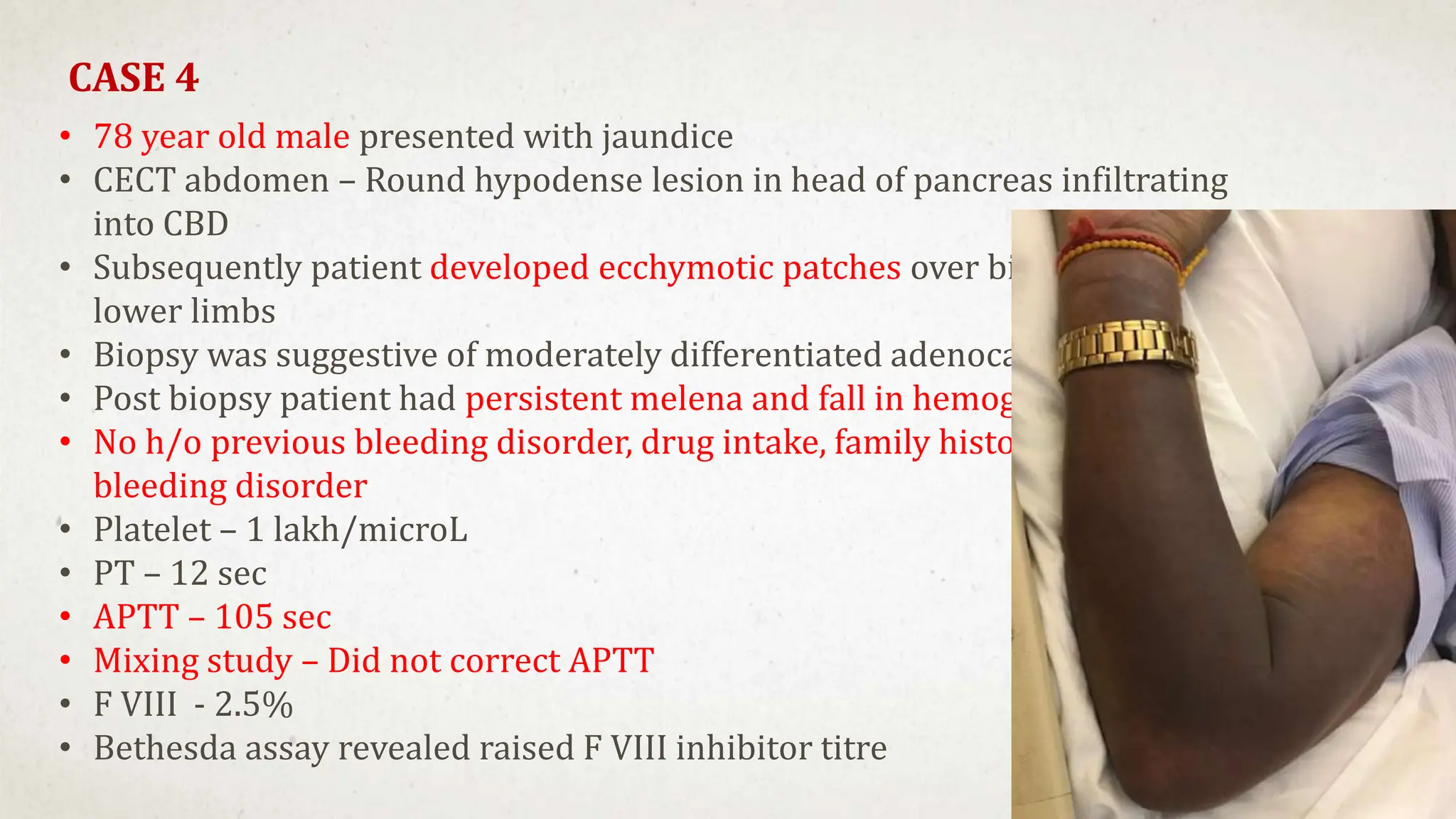 CASE 4
• 78 year old male presented with jaundice
• CECT abdomen – Round hypodense lesion in head of pancreas infiltrating
into CBD
• Subsequently patient developed ecchymotic patches over bilateral upper and
lower limbs
• Biopsy was suggestive of moderately differentiated adenocarcinoma
• Post biopsy patient had persistent melena and fall in hemoglobin
• No h/o previous bleeding disorder, drug intake, family history of any
bleeding disorder
• Platelet – 1 lakh/microL
• PT – 12 sec
• APTT – 105 sec
• Mixing study – Did not correct APTT
• F VIII - 2.5%
• Bethesda assay revealed raised F VIII inhibitor titre
 