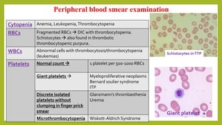 Peripheral blood smear examination
Cytopenia Anemia, Leukopenia,Thrombocytopenia
RBCs Fragmented RBCs  DIC with thrombocytopenia.
Schistocytes  also found in thrombotic
thrombocytopenic purpura.
WBCs Abnormal cells with thrombocytosis/thrombocytopenia
(leukemias)
Platelets Normal count  1 platelet per 500-1000 RBCs
Giant platelets  Myeloproliferative neoplasms
Bernard soulier syndrome
ITP
Discrete isolated
platelets without
clumping in finger prick
smear
Glanzmann’s thrombasthenia
Uremia
Microthrombocytopenia Wiskott-Aldrich Syndrome
Schistocytes inTTP
Giant platelet
 
