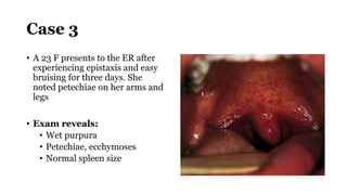 Case 3
• A 23 F presents to the ER after
experiencing epistaxis and easy
bruising for three days. She
noted petechiae on her arms and
legs
• Exam reveals:
• Wet purpura
• Petechiae, ecchymoses
• Normal spleen size
 