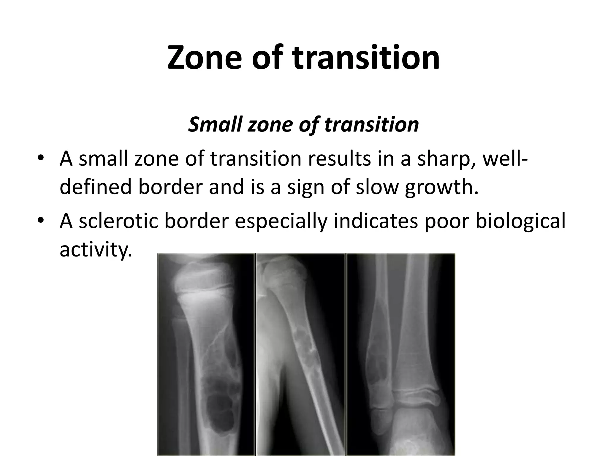 Zone of transition
Small zone of transition
• A small zone of transition results in a sharp, well-
defined border and is a sign of slow growth.
• A sclerotic border especially indicates poor biological
activity.
 