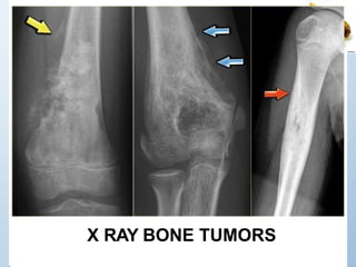 X RAY BONE TUMORS
 