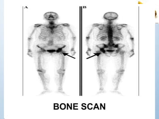 BONE SCAN
 