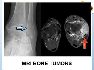 MRI BONE TUMORS
 