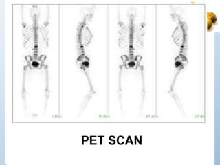 PET SCAN
 