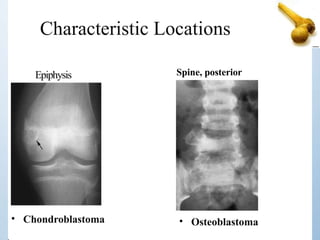 Characteristic Locations
• Chondroblastoma
Spine, posterior
Epiphysis
• Osteoblastoma
 