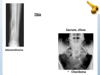 Tibia
Sacrum, clivus
Adamantinoma
• Chordoma
 