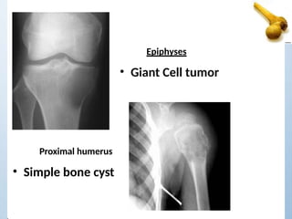 • Giant Cell tumor
Epiphyses
Proximal humerus
• Simple bone cyst
 