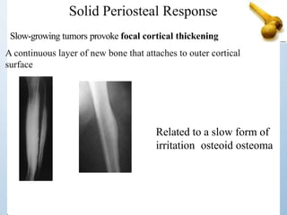 Solid Periosteal Response
Related to a slow form of
irritation osteoid osteoma
Slow-growing tumors provoke focal cortical thickening
A continuous layer of new bone that attaches to outer cortical
surface
 