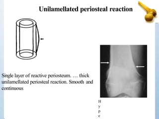 Unilamellated periosteal reaction
Single layer of reactive periosteum. … thick
unilamellated periosteal reaction. Smooth and
continuous
H
y
p
e
 