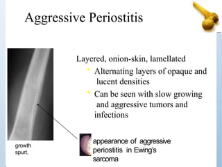 Aggressive Periostitis
appearance of aggressive
periostitis in Ewing’s
sarcoma
Layered, onion-skin, lamellated
• Alternating layers of opaque and
lucent densities
• Can be seen with slow growing
and aggressive tumors and
infections
growth
spurt.
 