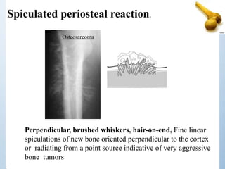 Spiculated periosteal reaction.
Perpendicular, brushed whiskers, hair-on-end, Fine linear
spiculations of new bone oriented perpendicular to the cortex
or radiating from a point source indicative of very aggressive
bone tumors
Osteosarcoma
 