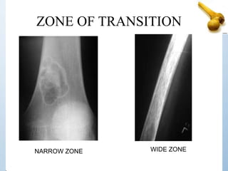 NARROW ZONE WIDE ZONE
ZONE OF TRANSITION
 