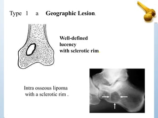 Type 1 a Geographic Lesion.
Intra osseous lipoma
with a sclerotic rim .
Well-defined
lucency
with sclerotic rim.
 