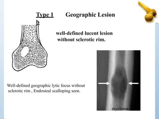 Type 1
b
Geographic Lesion
well-defined lucent lesion
without sclerotic rim.
Well-defined geographic lytic focus without
sclerotic rim , Endosteal scalloping seen.
myeloma
 