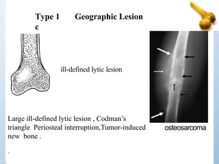 Large ill-defined lytic lesion , Codman’s
triangle Periosteal interruption,Tumor-induced
new bone .
.
Type 1
c
Geographic Lesion
ill-defined lytic lesion
osteosarcoma
 
