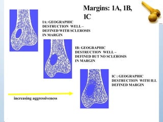 IA: GEOGRAPHIC
DESTRUCTION WELL –
DEFINED WITH SCLEROSIS
IN MARGIN
IB: GEOGRAPHIC
DESTRUCTION WELL –
DEFINED BUT NO SCLEROSIS
IN MARGIN
IC : GEOGRAPHIC
DESTRUCTION WITH ILL
DEFINED MARGIN
increasing aggressiveness
Margins: 1A, 1B,
1C
 