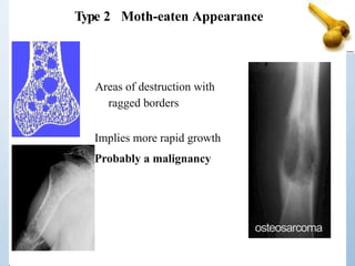 Type 2 Moth-eaten Appearance
Areas of destruction with
ragged borders
Implies more rapid growth
Probably a malignancy
osteosarcoma
 