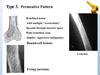 Type 3. Permeative Pattern
Ewing sarcoma.
ill-defined lesion
with multiple “worm-holes”
Spreads through marrow space
Wide transition zone
Implies aggressive malignancy
Round-cell lesions
Leukemia
 