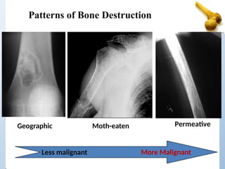 Patterns of Bone Destruction
Geographic Moth-eaten Permeative
Less malignant More Malignant
 