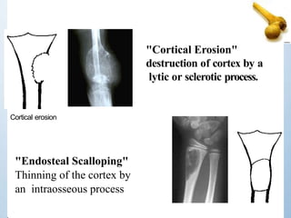 Cortical erosion
"Cortical Erosion"
destruction of cortex by a
lytic or sclerotic process.
"Endosteal Scalloping"
Thinning of the cortex by
an intraosseous process
 