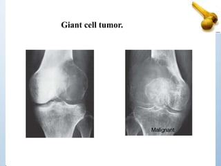 Giant cell tumor.
Malignant
 