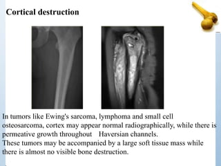 Cortical destruction
In tumors like Ewing's sarcoma, lymphoma and small cell
osteosarcoma, cortex may appear normal radiographically, while there is
permeative growth throughout Haversian channels.
These tumors may be accompanied by a large soft tissue mass while
there is almost no visible bone destruction.
 
