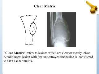 "Clear Matrix" refers to lesions which are clear or mostly clear.
A radiolucent lesion with few undestroyed trabeculae is considered
to have a clear matrix.
Clear Matrix
 