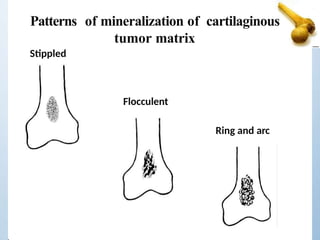 Patterns of mineralization of cartilaginous
tumor matrix
Stippled
Flocculent
Ring and arc
 