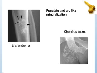 Enchondroma
Punctate and arc like
mineralization
Chondrosarcoma
 