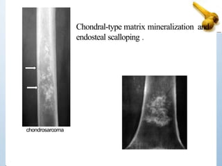 Chondral-type matrix mineralization and
endosteal scalloping .
chondrosarcoma
 