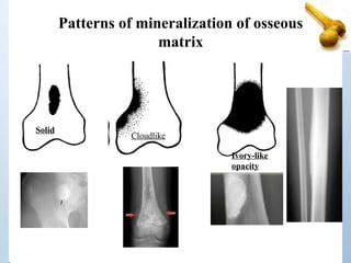 Solid
Patterns of mineralization of osseous
matrix
Ivory-like
opacity
Cloudlike
 