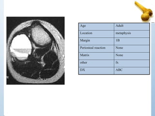 Age Adult
Location metaphysis
Margin 1B
Periosteal reaction None
Matrix None
other fx
DX ABC
 