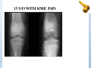 13 Y/O WITH KNEE PAIN
 