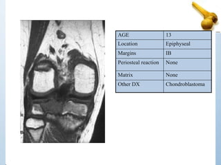 AGE 13
Location Epiphyseal
Margins IB
Periosteal reaction None
Matrix None
Other DX Chondroblastoma
 