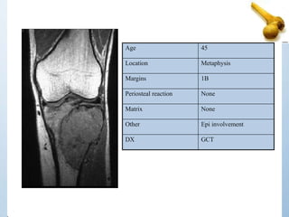 Age 45
Location Metaphysis
Margins 1B
Periosteal reaction None
Matrix None
Other Epi involvement
DX GCT
 
