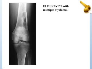 ELDERLY PT with
multiple myeloma.
 