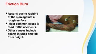 Friction Burn Def APPROACH TO BURN PATIENT.pptx #skin#burn#managment#TBSA#Debridemen | PPTX