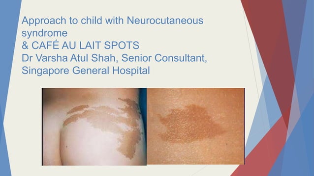 approach-to-cafe-au-lait-spots-in-children
