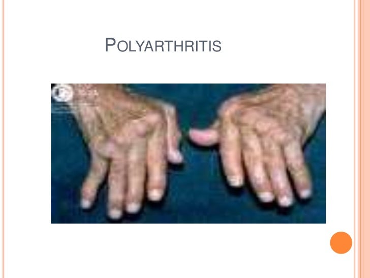 Approach to case of arthritis
