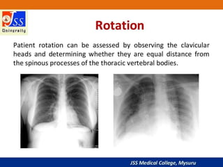 APPROACH TO CHEST X RAYS.pptx