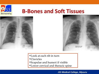 APPROACH TO CHEST X RAYS.pptx